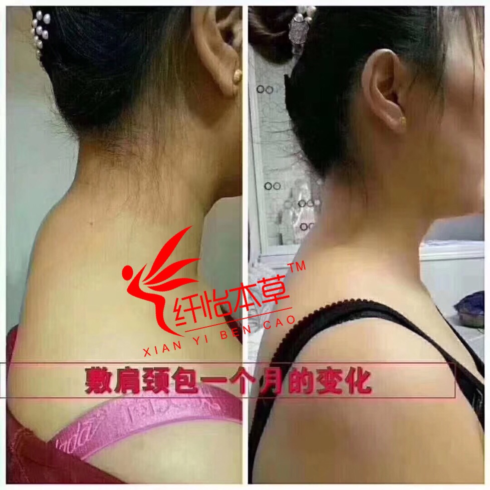 汉草热敷肩颈包案例